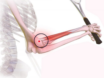 BLESSURE: Wat te doen bij epicondylitis of tenniselleboog?